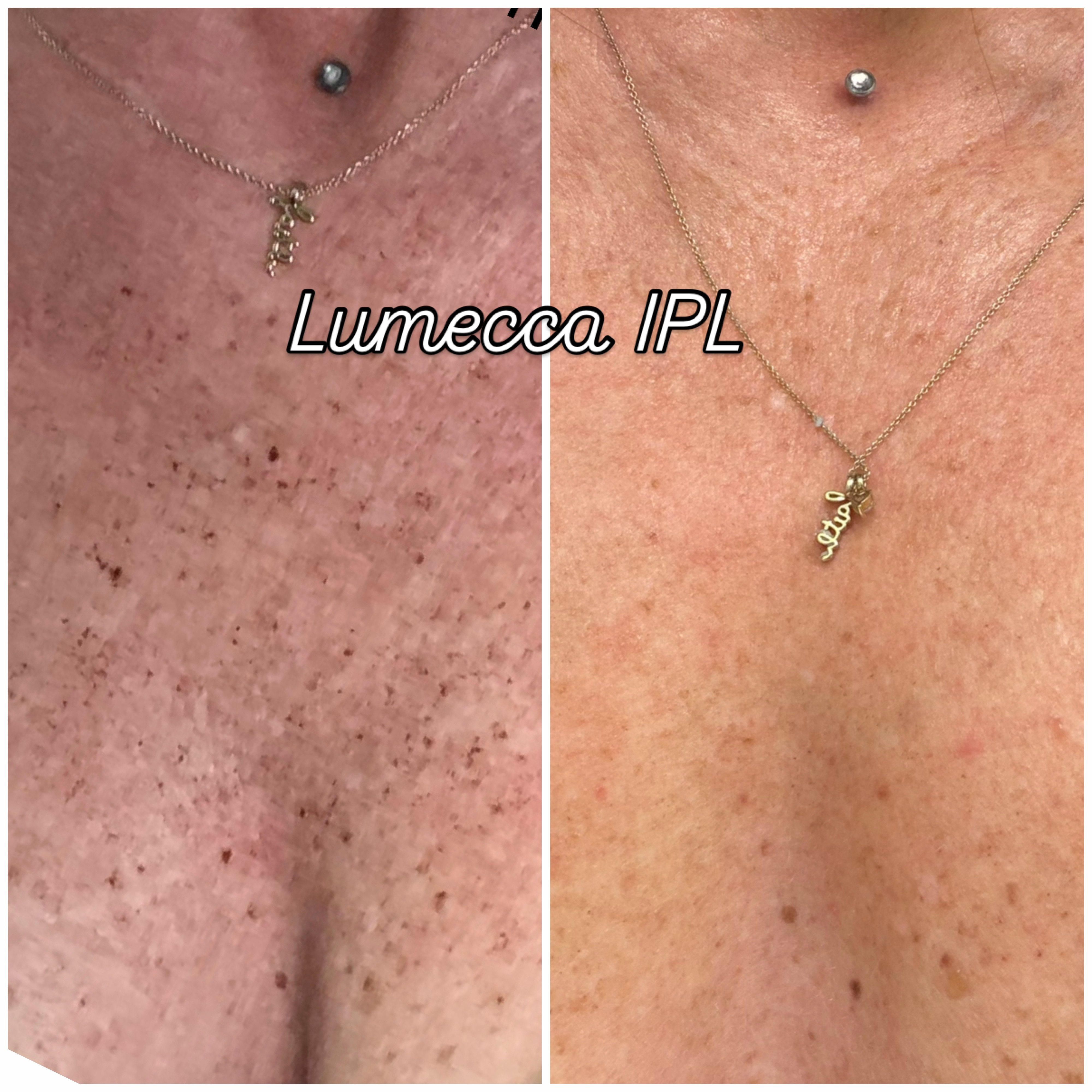 Lumecca IPL chest before and after result