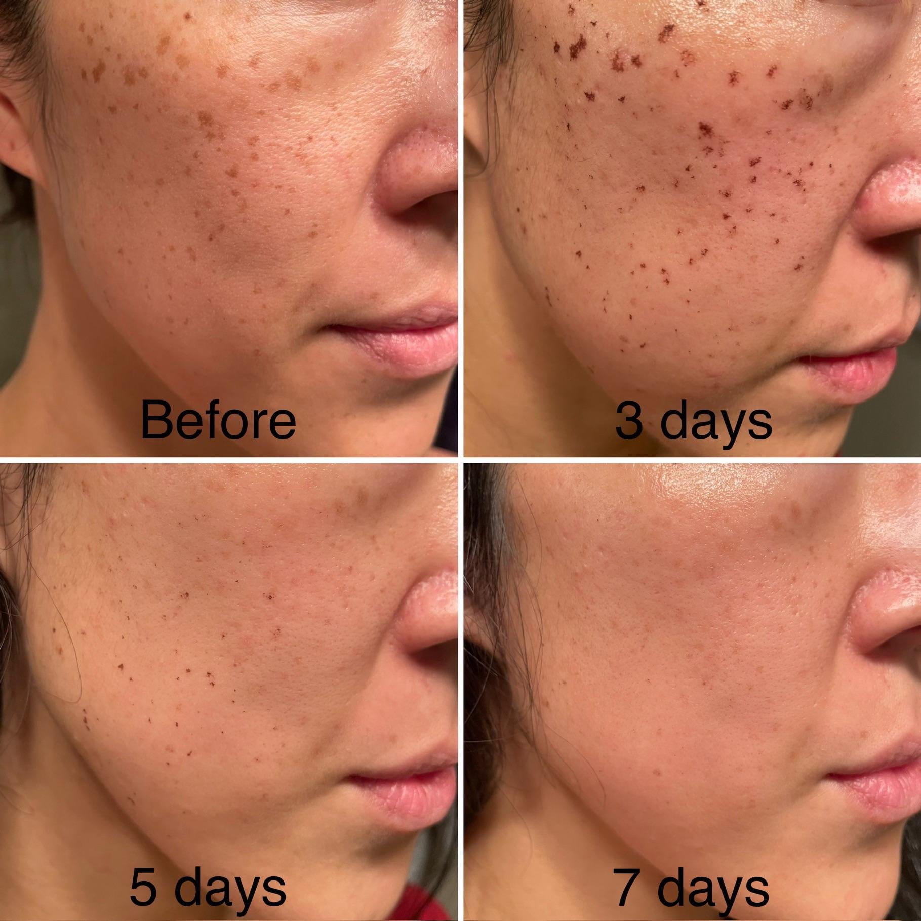 Lumecca IPL recovery progress example