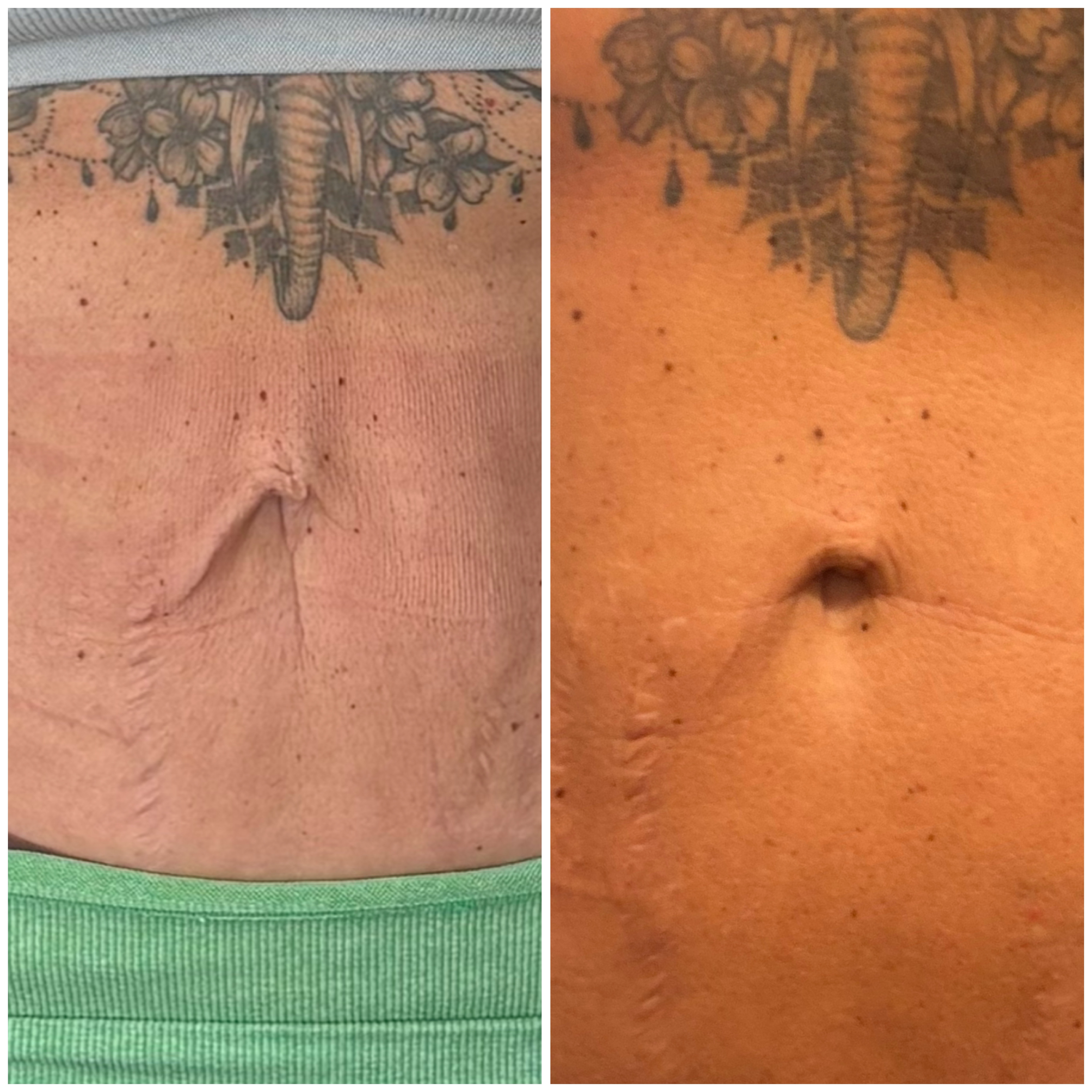 Morpheus8 abdomen before and after result