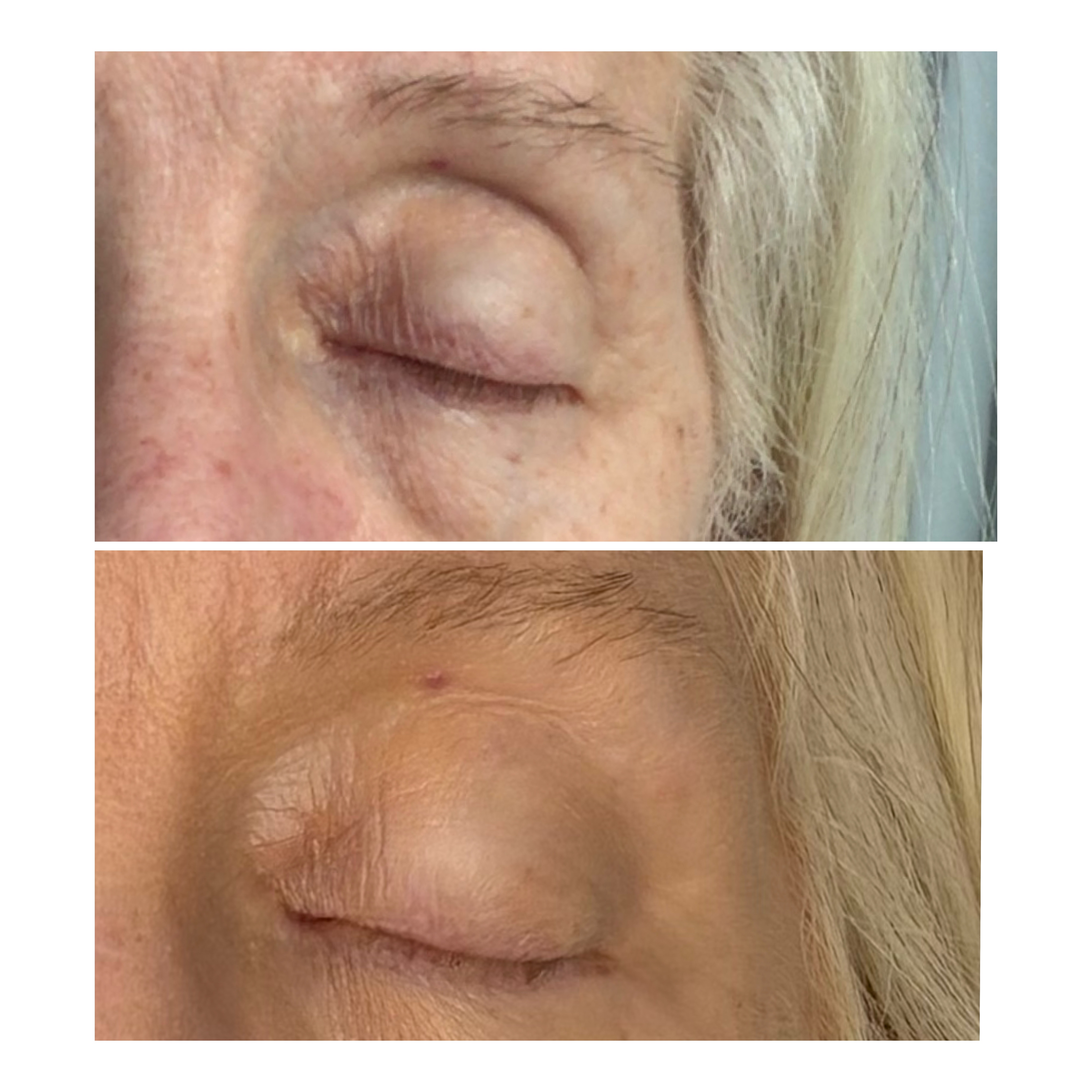 Morpheus8 eye area before and after result