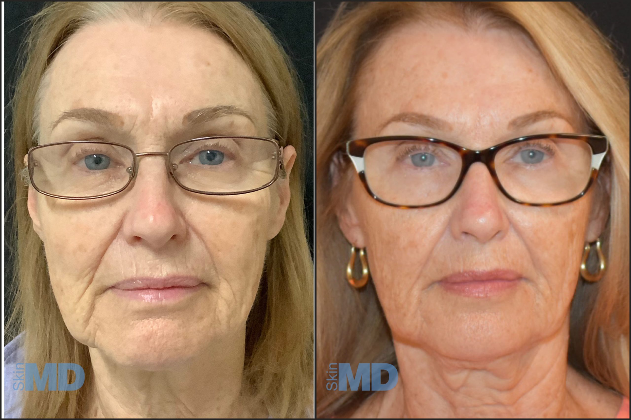 Morpheus8 face before and after result