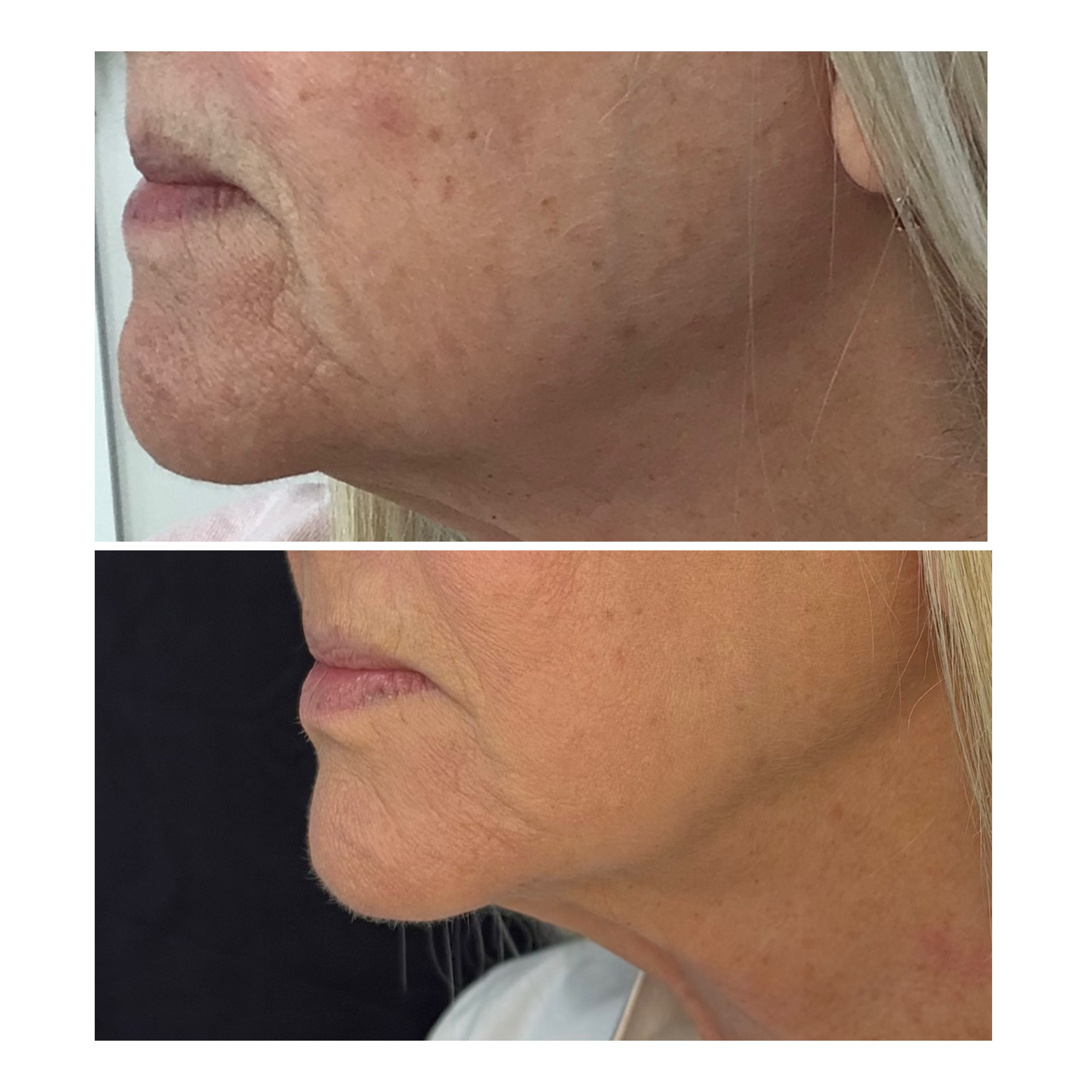 Morpheus8 neck profile before and after result